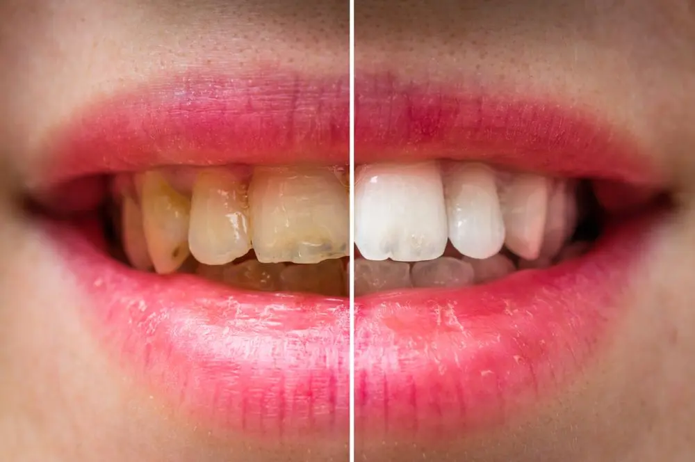 Blanquear los Dientes de Forma Casera