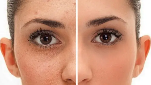 Remedios Naturales para el Acné y las Manchas