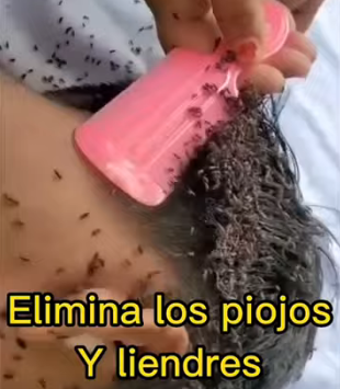 Remedio casero para eliminar los piojos